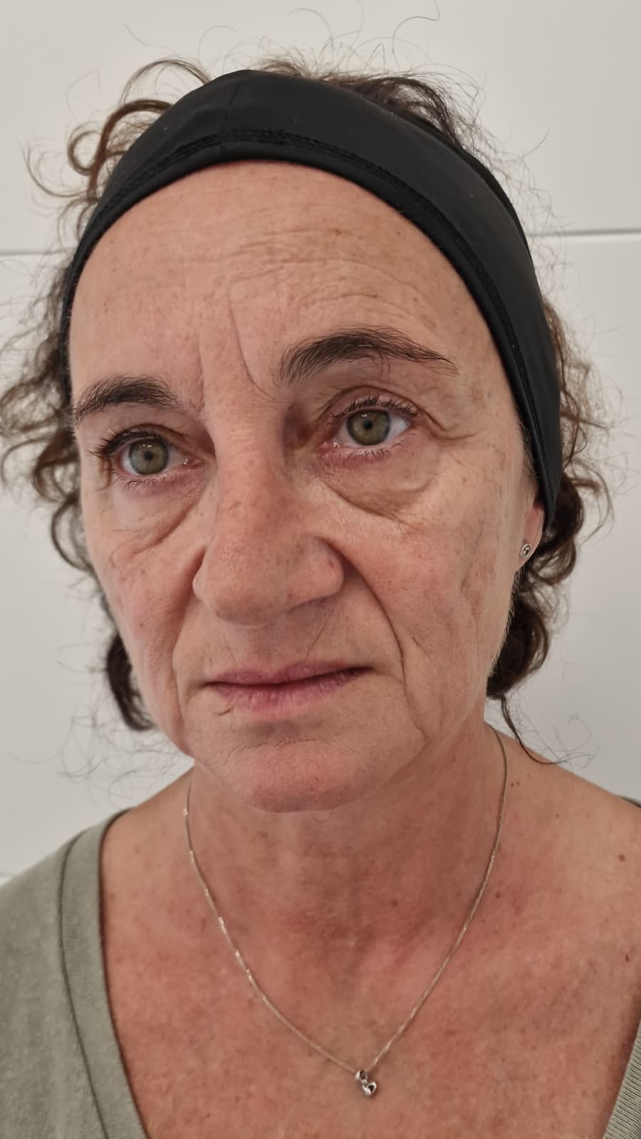 Antes de la armonización facial