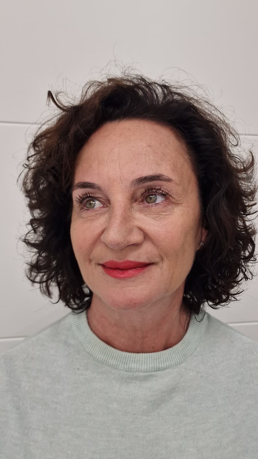 Después de la armonización facial