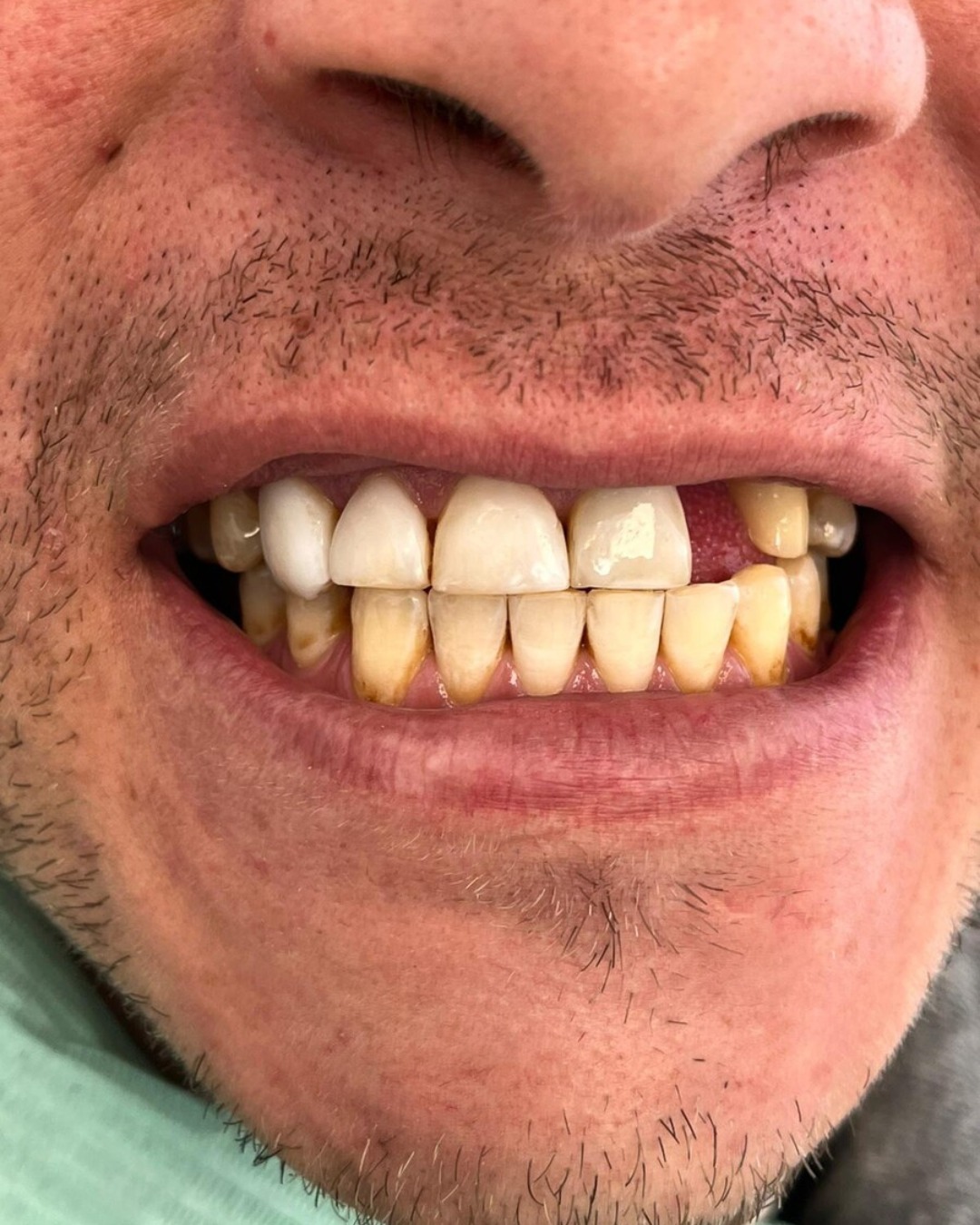 Antes del tratamiento dental