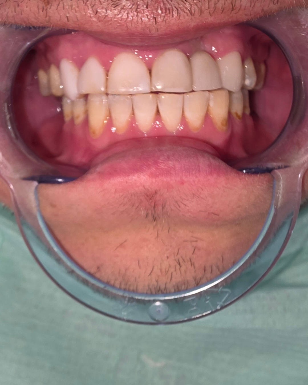 Después del tratamiento dental
