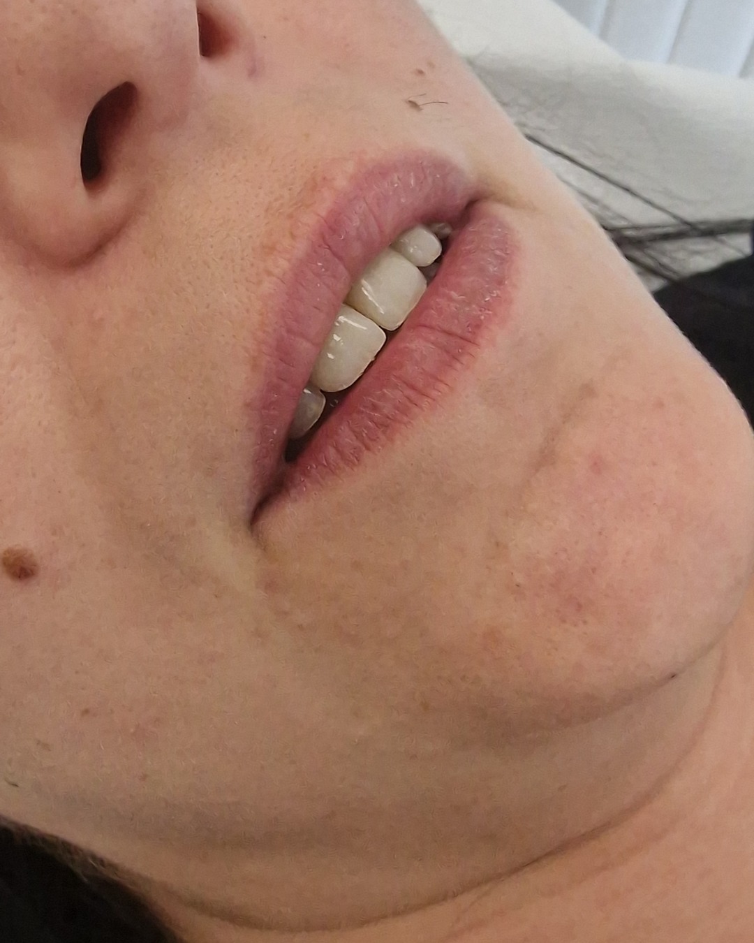 Antes del aumento de labios