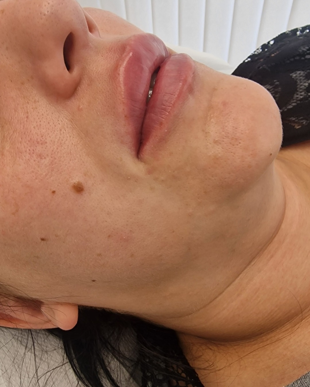 Después del aumento de labios