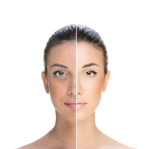 Eliminación de melasma