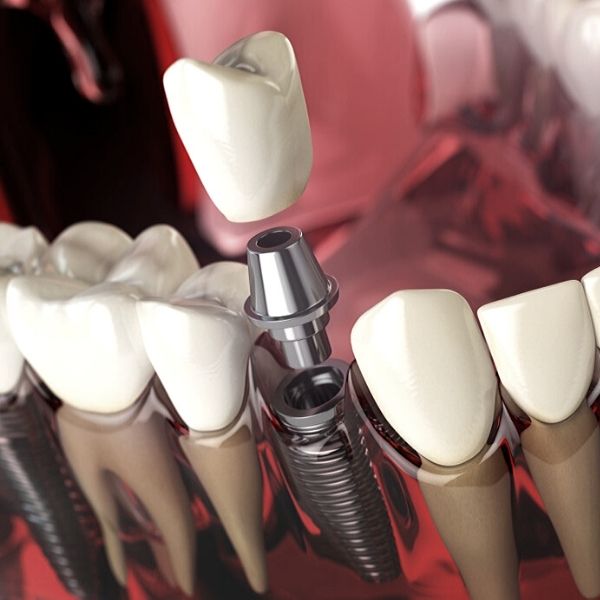 Implantes Dentales